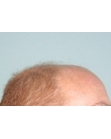 Before Hair Transplant&nbsp;2 Sessions (Areas)